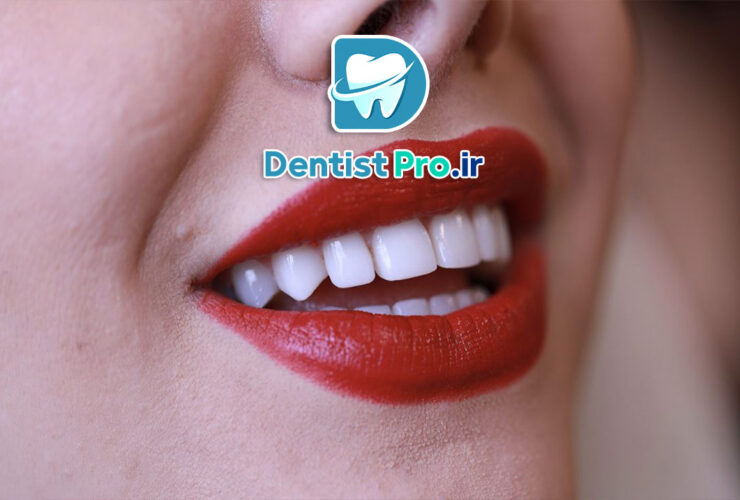 کامپوزیت مخصوص لبخندهای خاص؛ هنر لبخندسازی برای چهره‌های منحصربه‌فرد