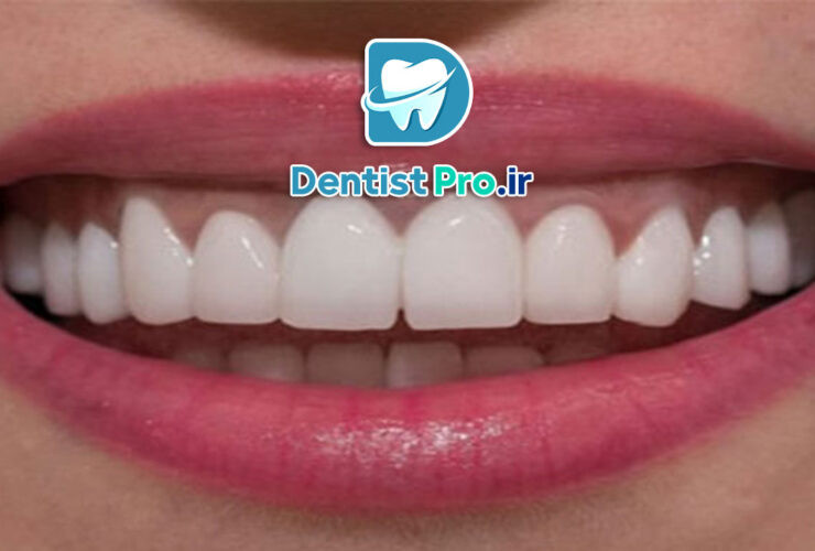 کامپوزیت بدون تراش: راهکاری نوین و کم‌تهاجمی در زیبایی دندان