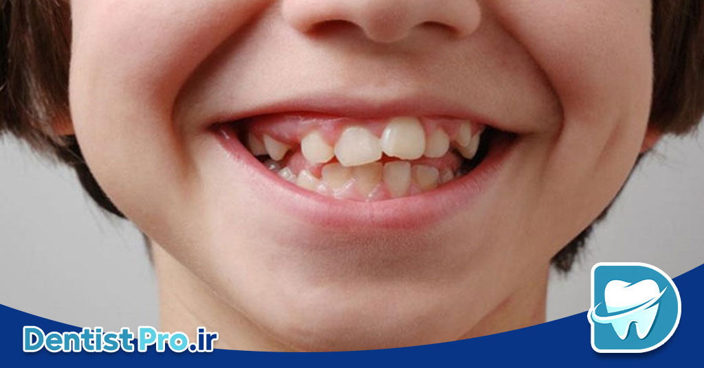 ناهنجاری دندانی در کودکان: علل، انواع، درمان‌ها و راه‌های پیشگیری