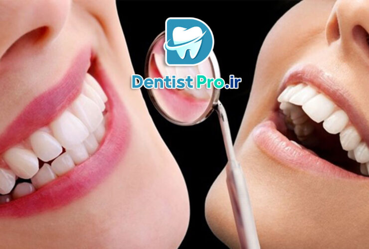 باندینگ دندان: روشی ساده و موثر برای اصلاح ظاهر دندان‌ها