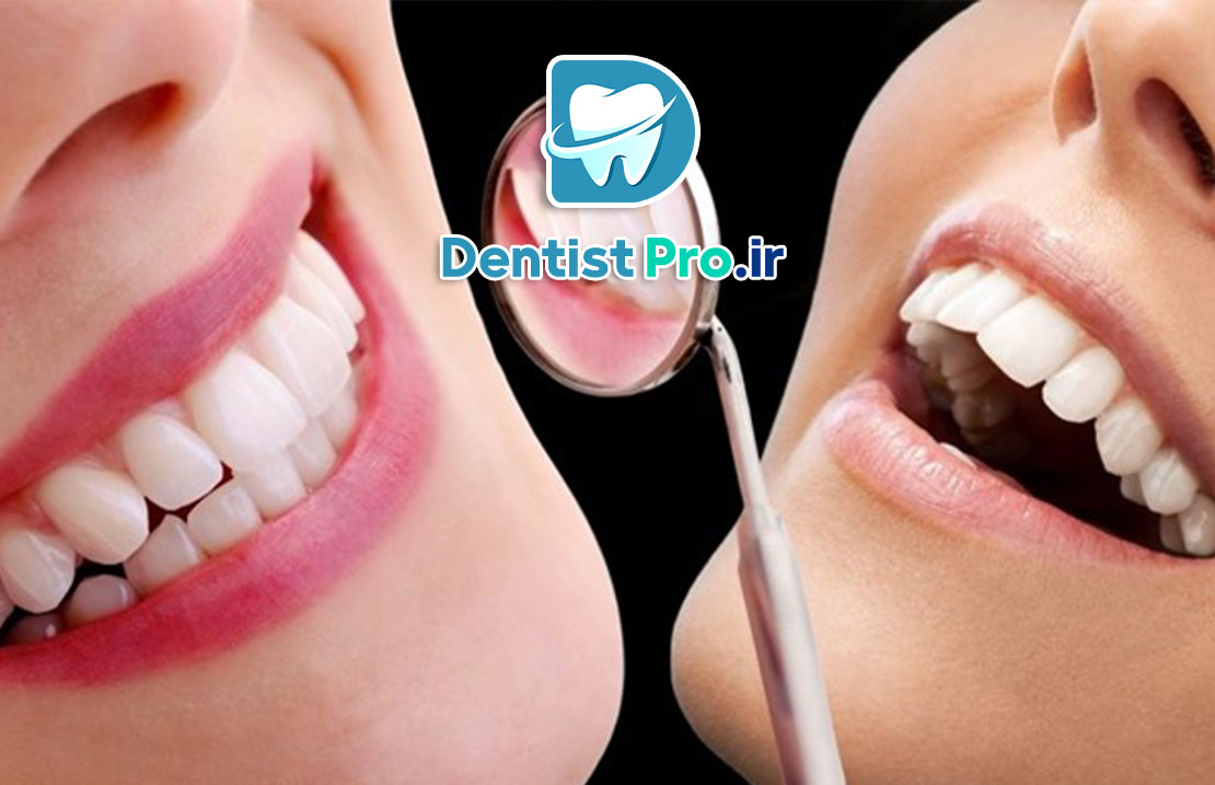 باندینگ دندان: روشی ساده و موثر برای اصلاح ظاهر دندان‌ها