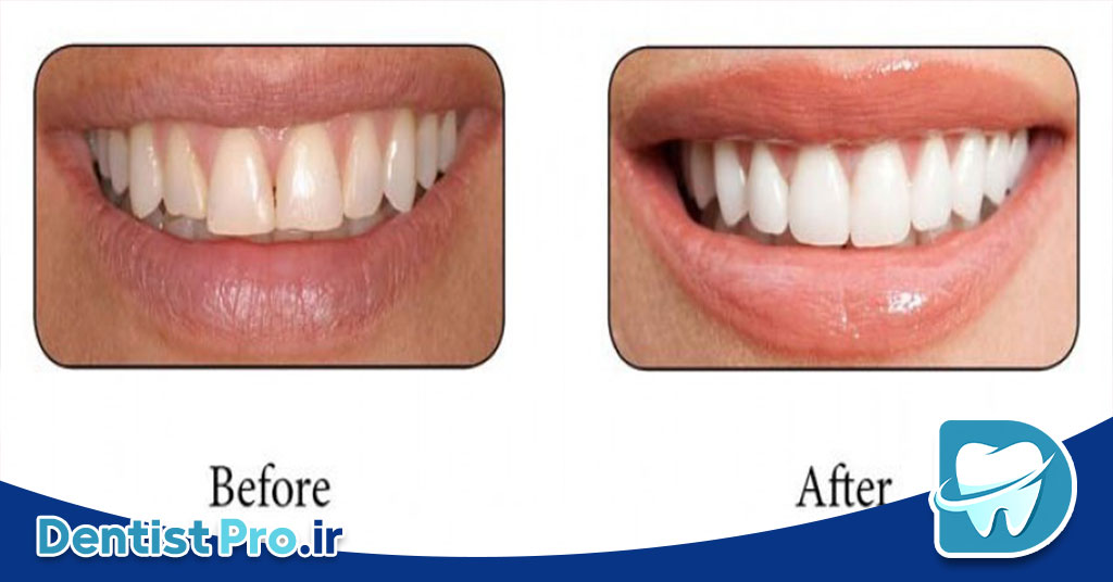 باندینگ دندان: روشی ساده و موثر برای اصلاح ظاهر دندان‌ها