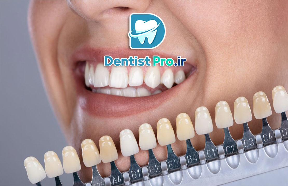 رنگبندی کامپوزیت دندان: راهنمای کامل برای انتخاب رنگ مناسب و تأثیرات آن در زیبایی لبخند