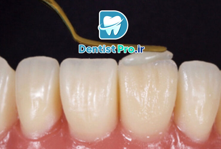 لایه گذاری کامپوزیتی؛ تکنیکی حرفه‌ای برای زیبایی و دوام دندان‌ها