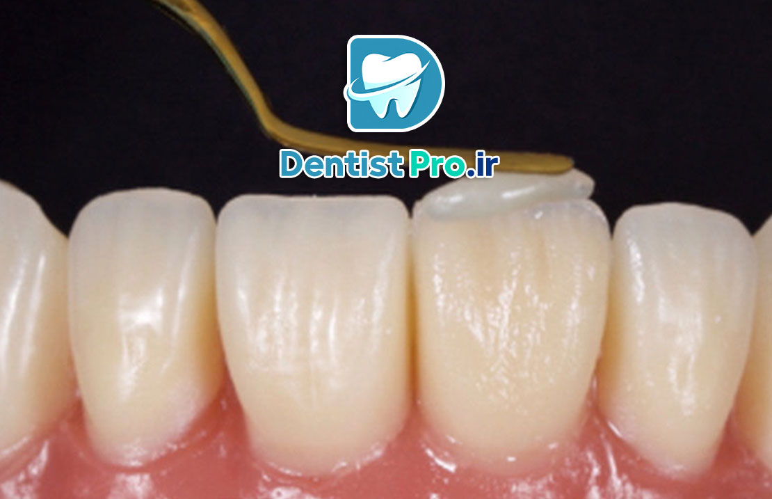 لایه گذاری کامپوزیتی؛ تکنیکی حرفه‌ای برای زیبایی و دوام دندان‌ها