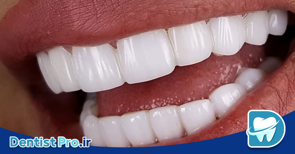 لایه گذاری کامپوزیتی؛ تکنیکی حرفه‌ای برای زیبایی و دوام دندان‌ها