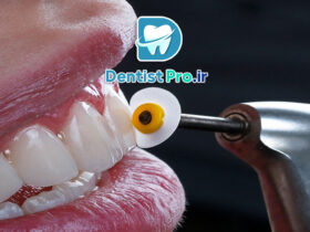 پالیش کامپوزیت دندان؛ راهی برای زیبایی و دوام بیشتر ترمیمهای کامپوزیتی 68 پالیش کامپوزیت دندان؛ راهی برای زیبایی و دوام بیشتر ترمیمهای کامپوزیتی