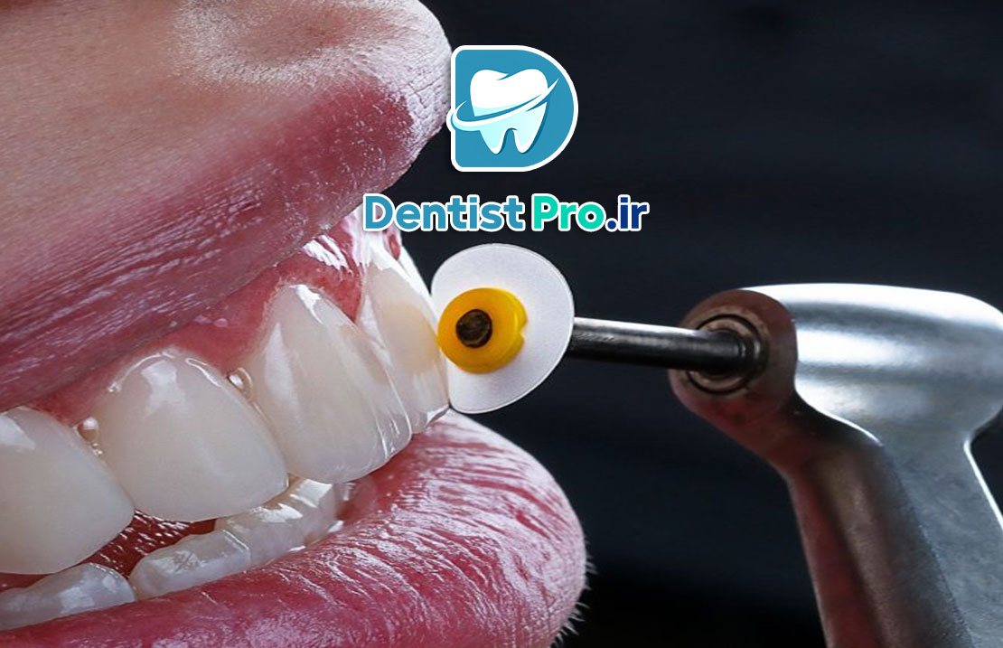 پالیش کامپوزیت دندان؛ راهی برای زیبایی و دوام بیشتر ترمیم‌های کامپوزیتی