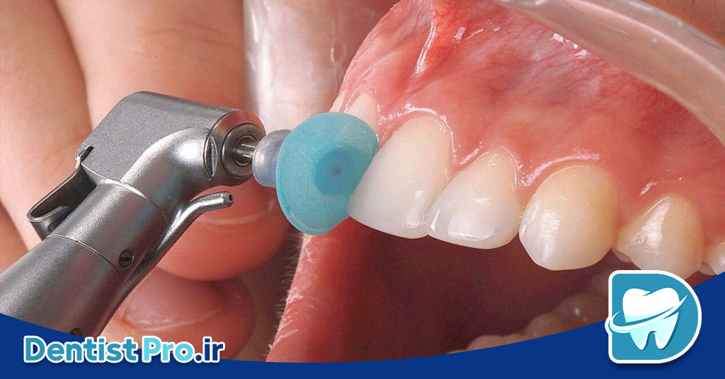 پالیش کامپوزیت دندان؛ راهی برای زیبایی و دوام بیشتر ترمیم‌های کامپوزیتی