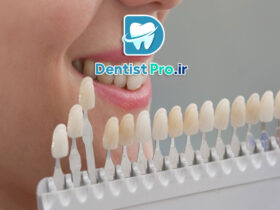 راهنمای کامل رنگبندی لمینت دندان: چگونه لبخندی طبیعیتر داشته باشیم؟ 57 راهنمای کامل رنگبندی لمینت دندان: چگونه لبخندی طبیعیتر داشته باشیم؟