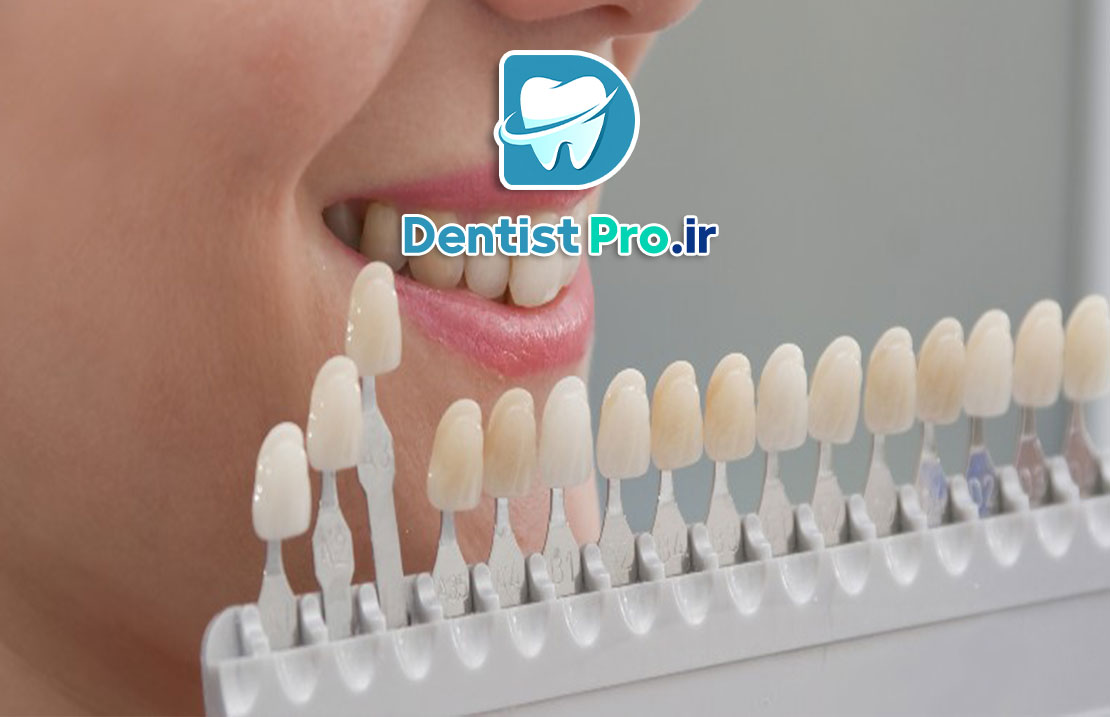 راهنمای کامل رنگبندی لمینت دندان: چگونه لبخندی طبیعیتر داشته باشیم؟ 25 راهنمای کامل رنگبندی لمینت دندان: چگونه لبخندی طبیعیتر داشته باشیم؟