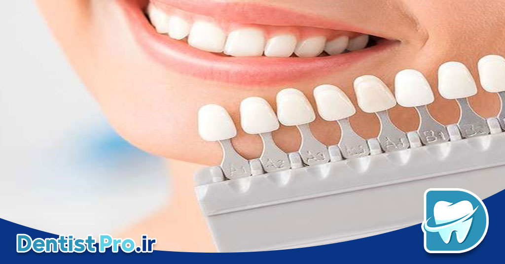 راهنمای کامل رنگبندی لمینت دندان: چگونه لبخندی طبیعیتر داشته باشیم؟ 29 راهنمای کامل رنگبندی لمینت دندان: چگونه لبخندی طبیعیتر داشته باشیم؟