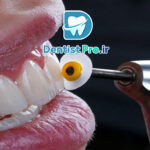 تراش دندان در دندانپزشکی: همه‌چیز درباره فرآیند، کاربردها و نکات مهم