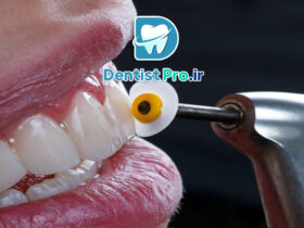 تراش دندان در دندانپزشکی: همه‌چیز درباره فرآیند، کاربردها و نکات مهم
