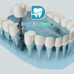 ایمپلنت دیجیتال: تحولی نوین در دندان‌پزشکی