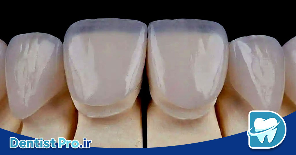 بررسی جامع دوام لمینت سرامیکی: زیبایی ماندگار برای لبخند شما