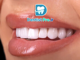 بررسی جامع دوام لمینت سرامیکی: زیبایی ماندگار برای لبخند شما 46 بررسی جامع دوام لمینت سرامیکی: زیبایی ماندگار برای لبخند شما