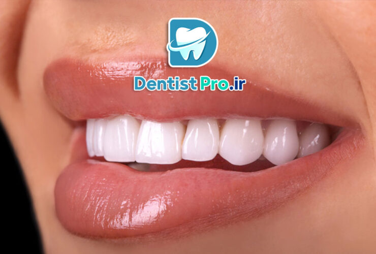 بررسی جامع دوام لمینت سرامیکی: زیبایی ماندگار برای لبخند شما