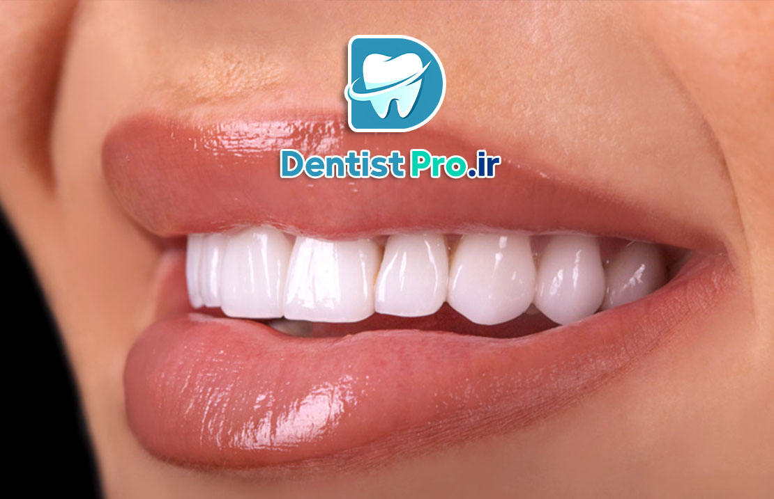 بررسی جامع دوام لمینت سرامیکی: زیبایی ماندگار برای لبخند شما