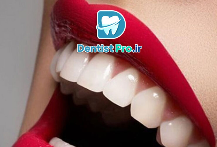 کامپوزیت دندان اقتصادی؛ راهکاری نوین برای زیبایی با هزینه مناسب