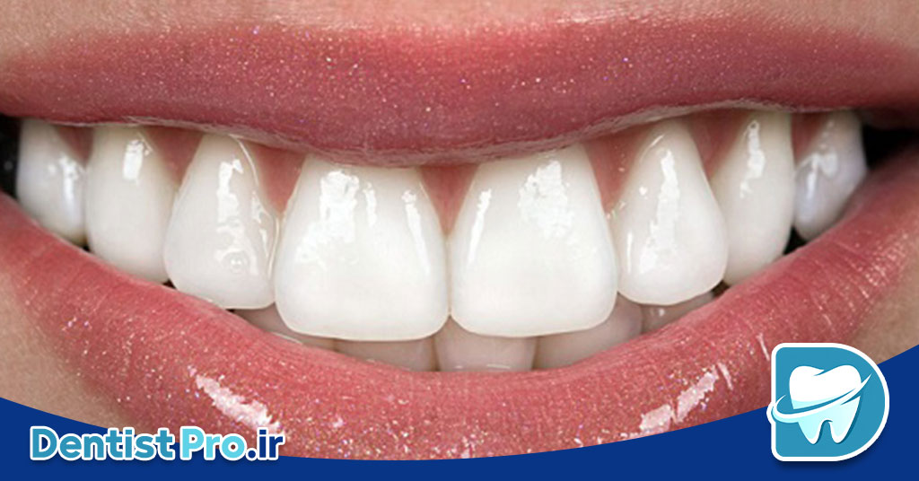 لمینت دندان انگلیسی: راهی به سوی لبخندی زیبا و طبیعی
