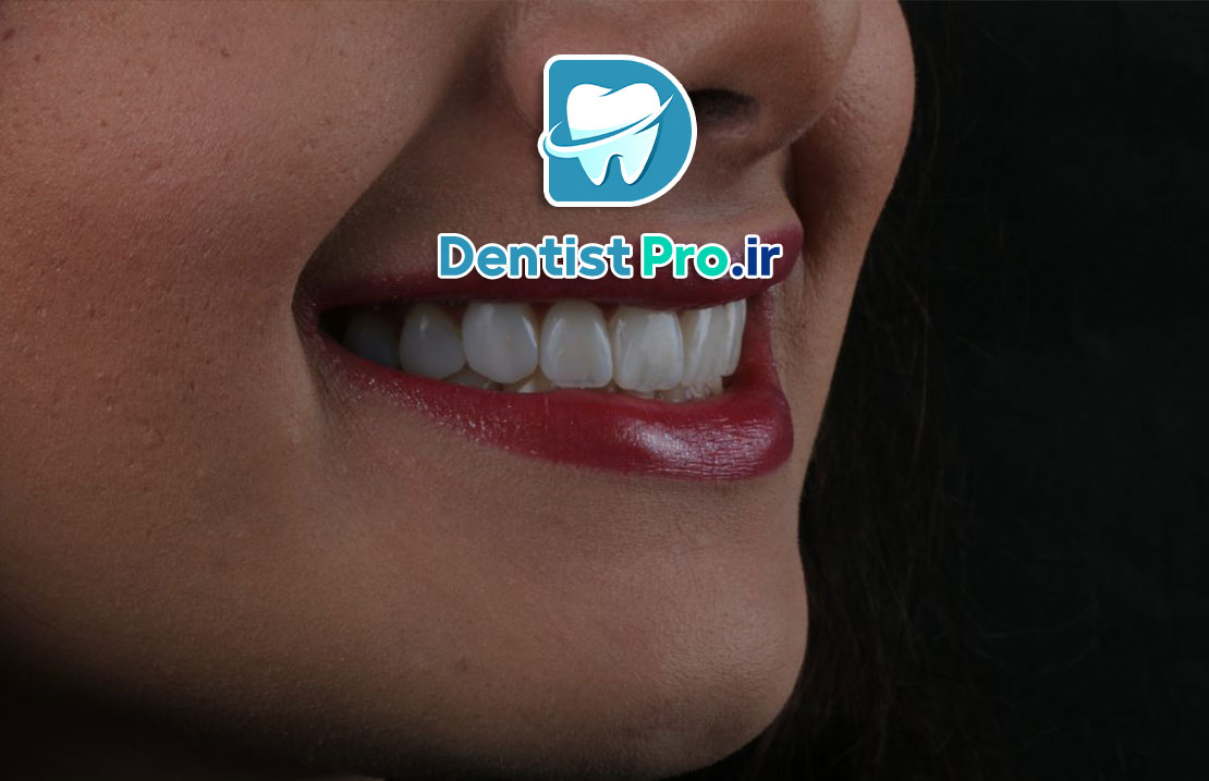 لمینت دندان انگلیسی: راهی به سوی لبخندی زیبا و طبیعی