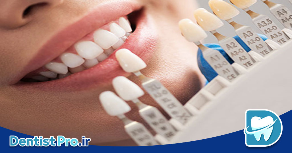 لمینت دندان آلمانی: ترکیبی از تکنولوژی، زیبایی و دوام