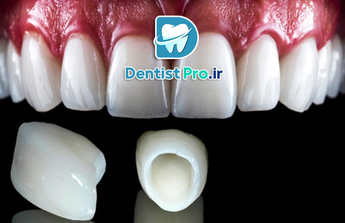 لمینت دندان ایمکس: بهترین انتخاب برای لبخندی طبیعی و زیبا 25 لمینت دندان ایمکس: بهترین انتخاب برای لبخندی طبیعی و زیبا