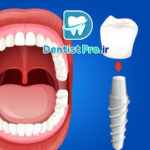 ایمپلنت در افراد سیگاری: چالش‌ها، عوارض و راهکارها