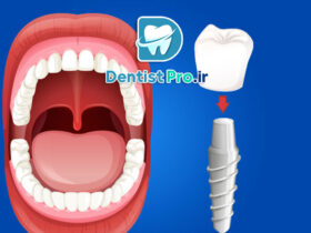 ایمپلنت در افراد سیگاری: چالش‌ها، عوارض و راهکارها