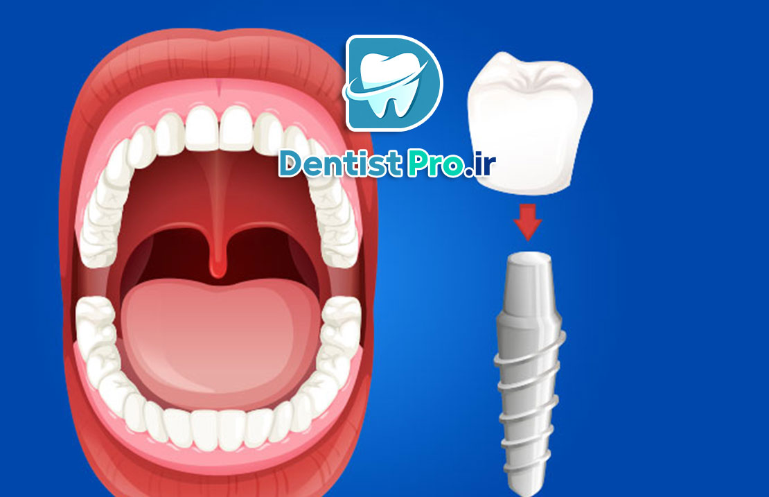 ایمپلنت در افراد سیگاری: چالشها، عوارض و راهکارها 25 ایمپلنت در افراد سیگاری: چالشها، عوارض و راهکارها