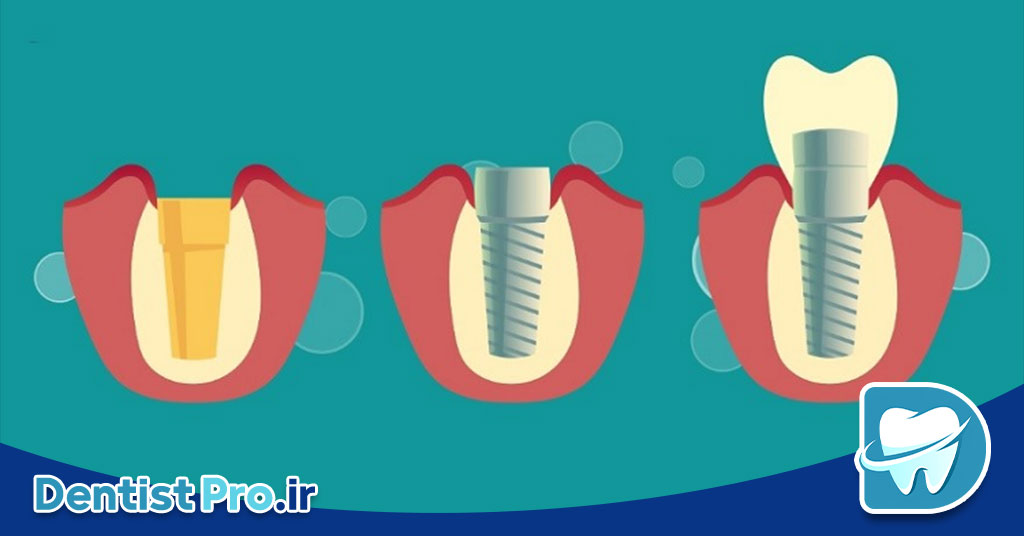 ایمپلنت در افراد سیگاری: چالشها، عوارض و راهکارها 29 ایمپلنت در افراد سیگاری: چالشها، عوارض و راهکارها