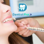 همه چیز درباره باندینگ لمینت: راهکاری نوین در زیبایی دندان