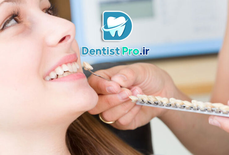 همه چیز درباره باندینگ لمینت: راهکاری نوین در زیبایی دندان