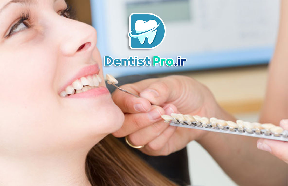 همه چیز درباره باندینگ لمینت: راهکاری نوین در زیبایی دندان 25 همه چیز درباره باندینگ لمینت: راهکاری نوین در زیبایی دندان