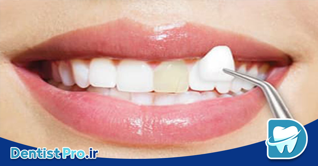 همه چیز درباره باندینگ لمینت: راهکاری نوین در زیبایی دندان 29 همه چیز درباره باندینگ لمینت: راهکاری نوین در زیبایی دندان