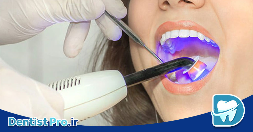 پر کردن دندان با لیزر: تحولی نوین در درمان پوسیدگی دندان