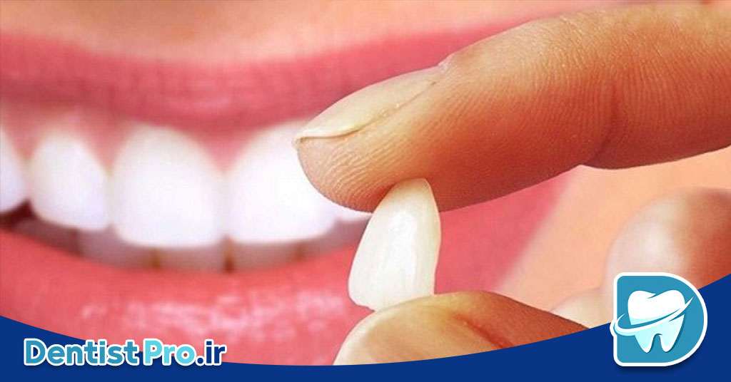 لمینت دندان چینی: راهی به سوی لبخندی زیبا و طبیعی 28 لمینت دندان چینی: راهی به سوی لبخندی زیبا و طبیعی