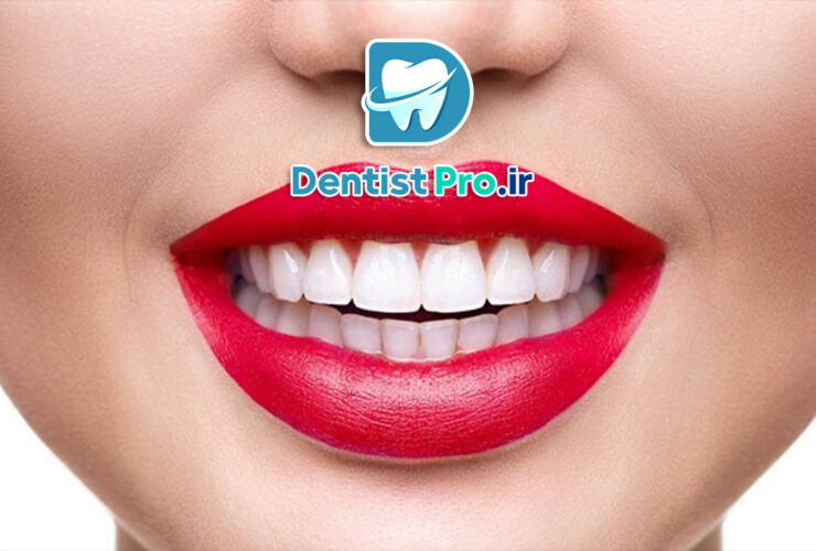 لمینت دندان چینی: راهی به سوی لبخندی زیبا و طبیعی