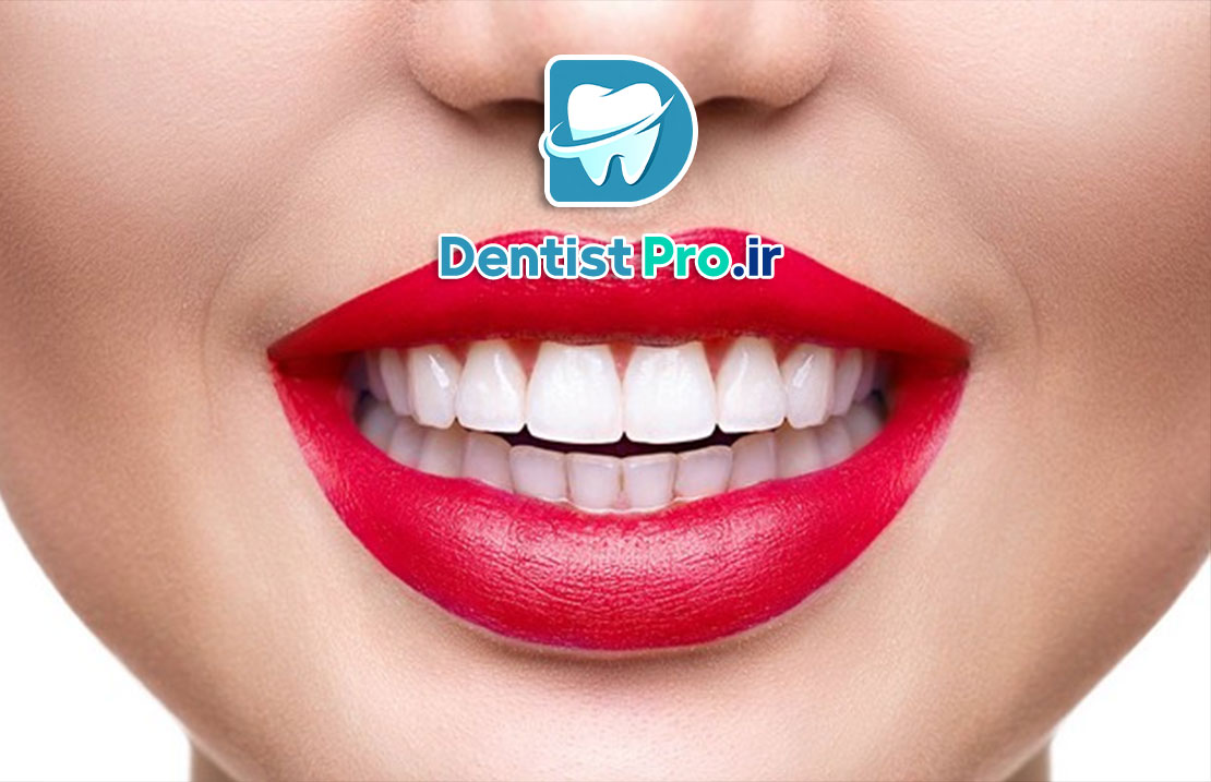 لمینت دندان چینی: راهی به سوی لبخندی زیبا و طبیعی 25 لمینت دندان چینی: راهی به سوی لبخندی زیبا و طبیعی