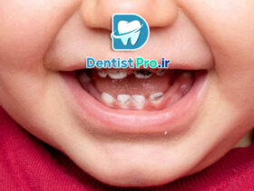 پوسیدگی زودرس دندان شیری: علل، علائم، پیشگیری و درمان