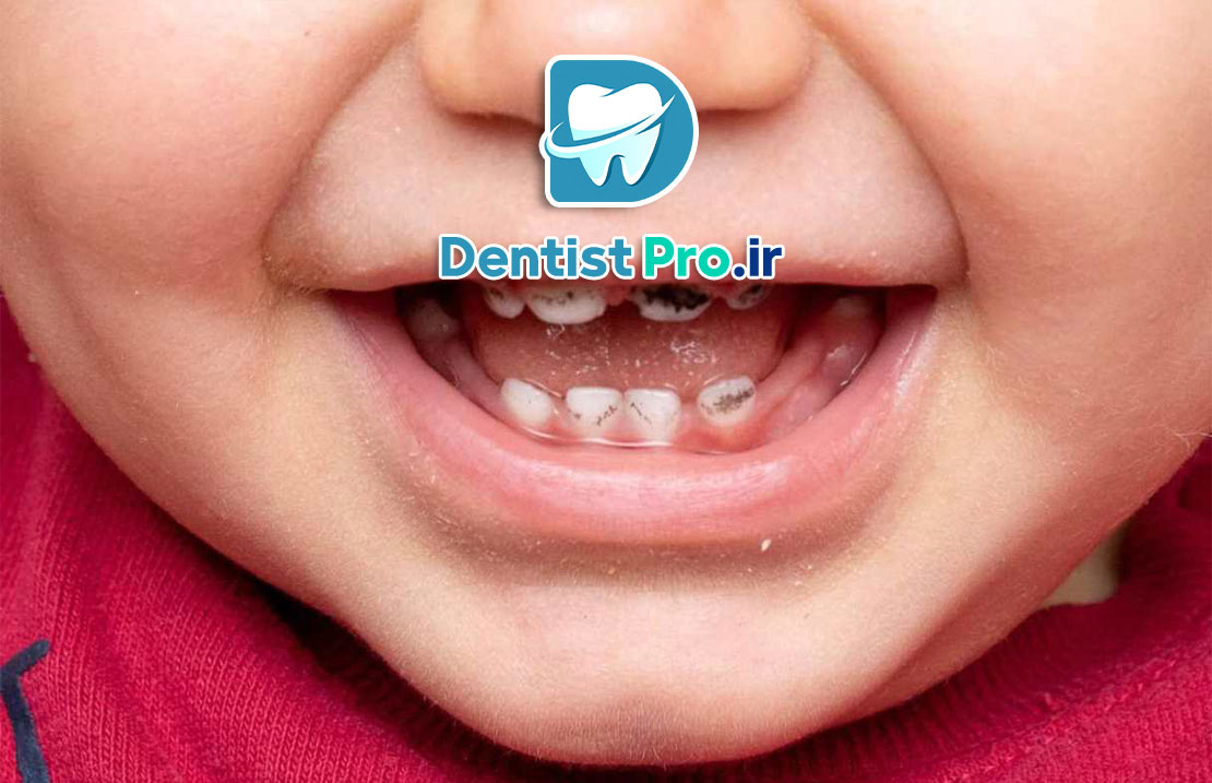 پوسیدگی زودرس دندان شیری: علل، علائم، پیشگیری و درمان