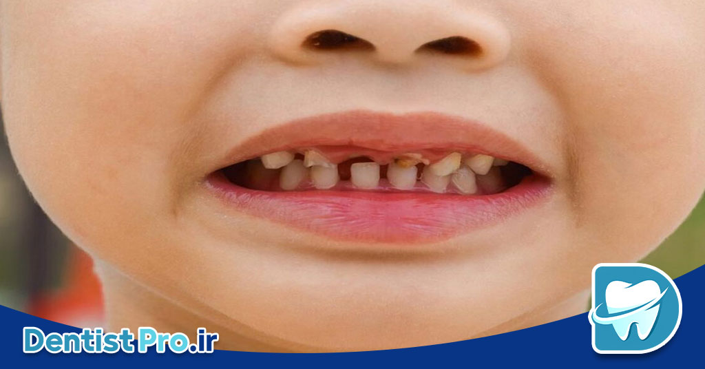 پوسیدگی زودرس دندان شیری: علل، علائم، پیشگیری و درمان