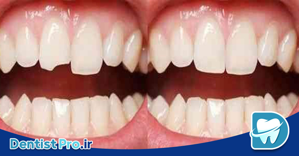ترمیم لب پریدگی دندان: راهنمای کامل برای بازگرداندن زیبایی و سلامت دندان