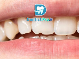 ترمیم لب پریدگی دندان: راهنمای کامل برای بازگرداندن زیبایی و سلامت دندان