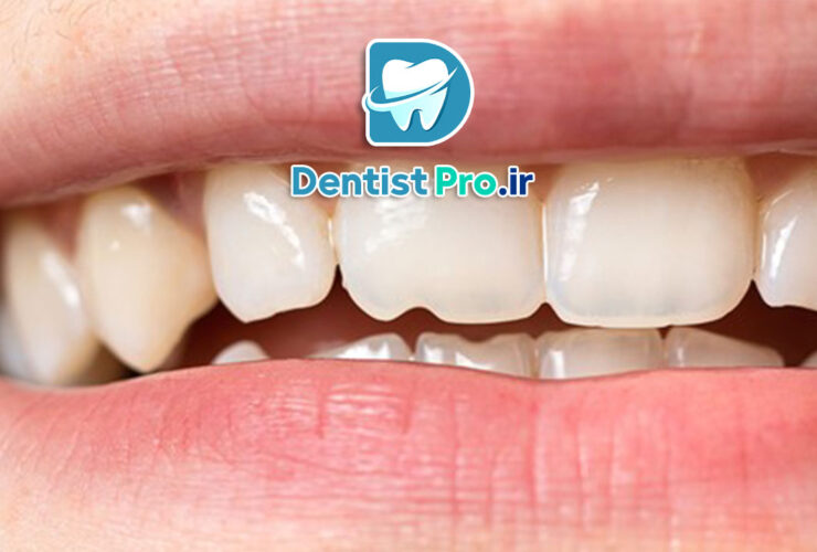 ترمیم لب پریدگی دندان: راهنمای کامل برای بازگرداندن زیبایی و سلامت دندان