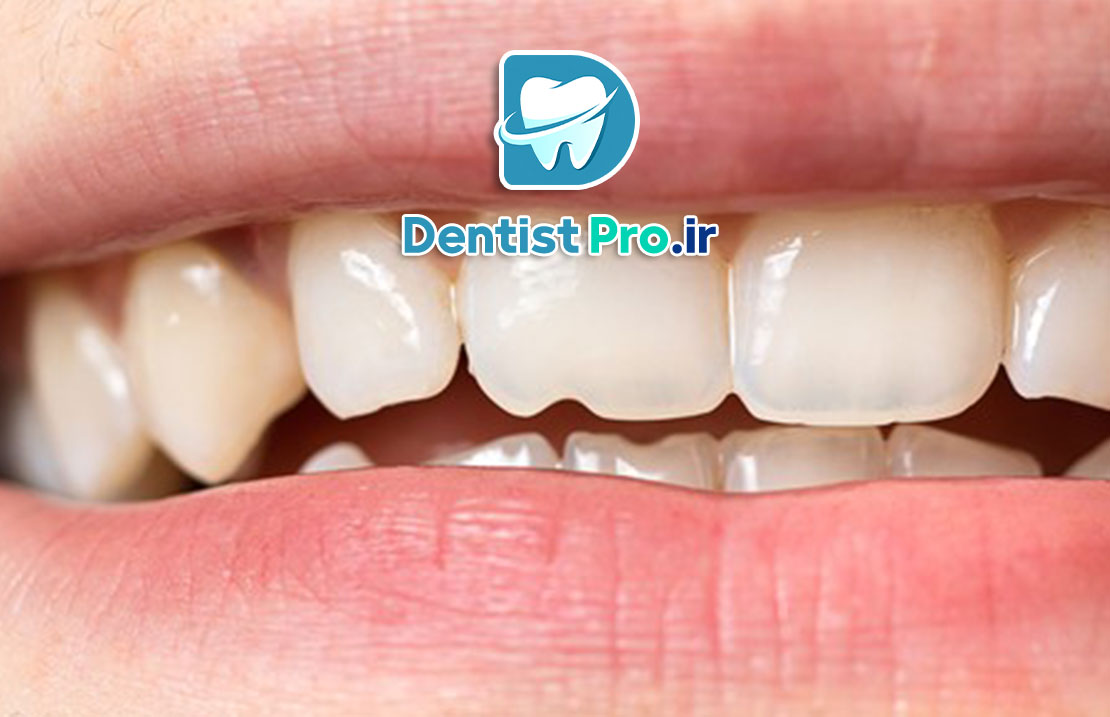 ترمیم لب پریدگی دندان: راهنمای کامل برای بازگرداندن زیبایی و سلامت دندان