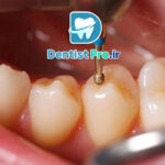 ترمیم دندان شیری با مواد همرنگ