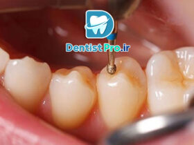 ترمیم دندان شیری با مواد همرنگ 57 ترمیم دندان شیری با مواد همرنگ