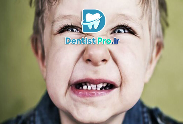 دندان قروچه در کودکان: علل، عوارض و روش‌های درمان